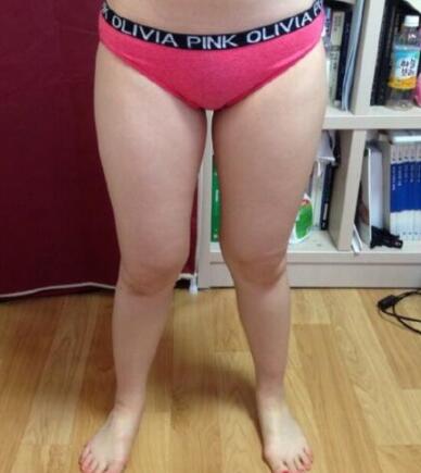 抽脂減肥瘦大腿價格10800元，一個月后恢復(fù)很好