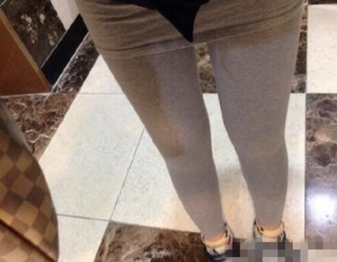 抽脂減肥瘦大腿價格10800元，一個月后恢復(fù)很好