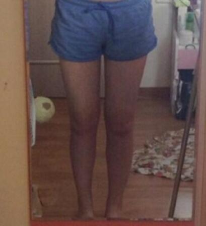 抽脂減肥瘦大腿價格10800元，一個月后恢復(fù)很好