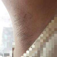 激光脫毛的價格380元，圖片分享