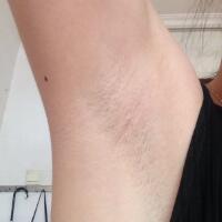 激光脫毛的價格380元，圖片分享