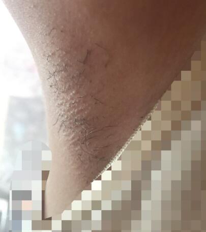 激光脫毛的價格380元，激光脫毛圖片分享