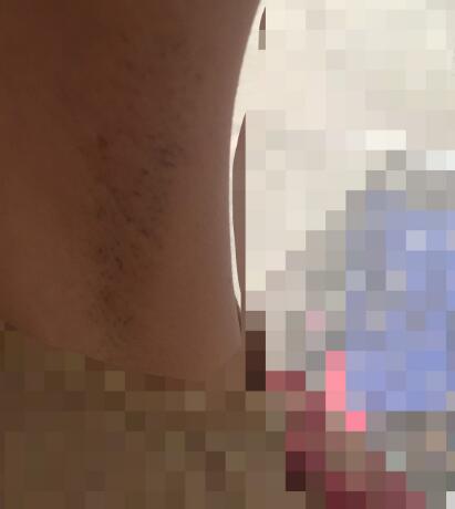 激光脫毛的價格380元，激光脫毛圖片分享