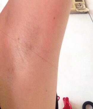 激光脫毛的價格380元，激光脫毛圖片分享