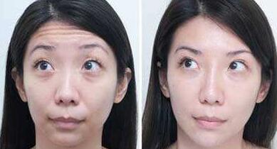 抬頭紋手術(shù)多少錢？去抬頭紋前后對比圖