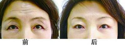 抬頭紋手術(shù)多少錢？去抬頭紋前后對比圖