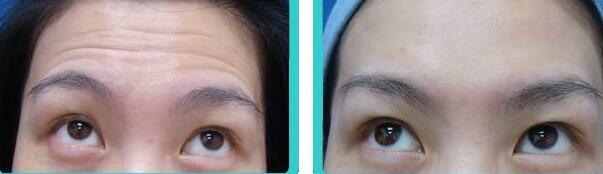 抬頭紋手術(shù)多少錢？去抬頭紋前后對比圖