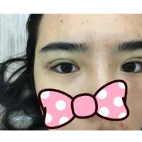 埋線雙眼皮恢復(fù)日志多對(duì)比圖分享