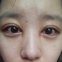 見證全切雙眼皮使單眼皮變雙眼皮的奇跡~恢復(fù)過程圖分享