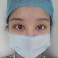 見證全切雙眼皮使單眼皮變雙眼皮的奇跡~恢復(fù)過程圖分享