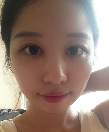 見證全切雙眼皮使單眼皮變雙眼皮的奇跡~恢復(fù)過程圖分享