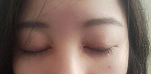 見證全切雙眼皮使單眼皮變雙眼皮的奇跡~恢復(fù)過程圖分享