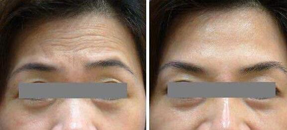 去抬頭紋前后對比圖，去抬頭紋手術多少錢？