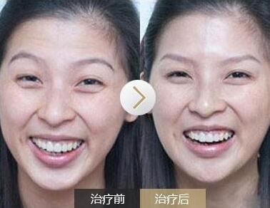 去抬頭紋前后對比圖，去抬頭紋手術多少錢？