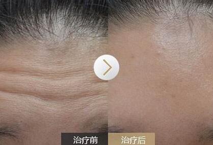 去抬頭紋前后對比圖，去抬頭紋手術多少錢？