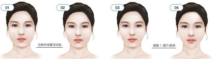 瘦臉前后對(duì)比圖，B****的價(jià)格曝光