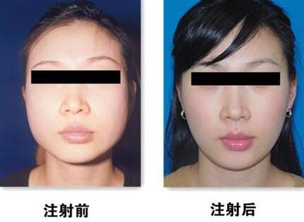 瘦臉前后對(duì)比圖，B****的價(jià)格曝光