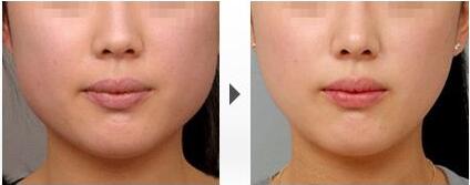 瘦臉前后對(duì)比圖，B****的價(jià)格曝光