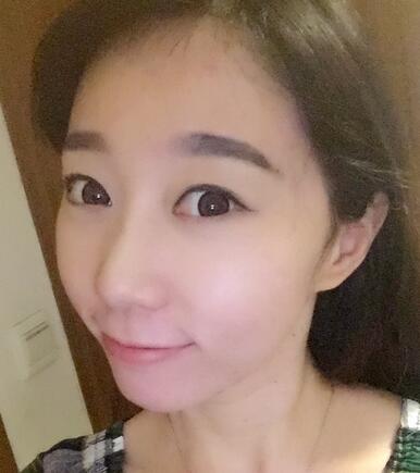 廣州倍生女性發(fā)際線調(diào)整案例