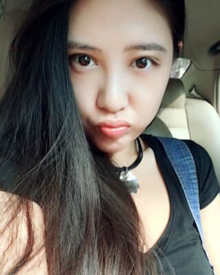 貴陽(yáng)麗都自體脂肪面部填充+雙下巴吸脂恢復(fù)圖片