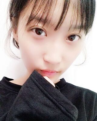 微創(chuàng)全切雙眼皮果對比照片，貴陽麗都葛志鑫手術案例