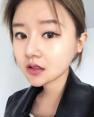 太原曹立銘面部吸脂瘦臉手術(shù)果圖