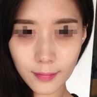 果酸嫩膚多少錢(qián)？我做成890元，果圖分享給大家