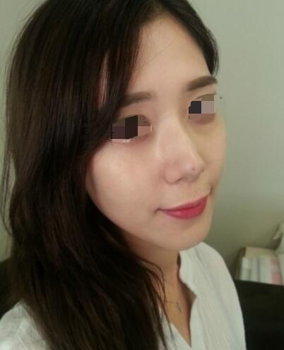 果酸嫩膚多少錢？我做成890元，果圖分享給大家