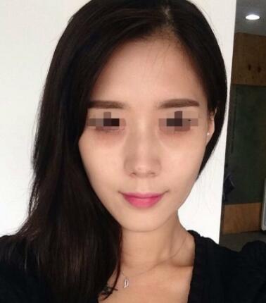 果酸嫩膚多少錢？我做成890元，果圖分享給大家