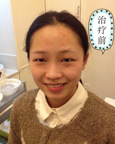 有人做過光子嫩膚嗎？自己做過，感覺果不錯分享