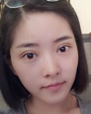 全切微創(chuàng)雙眼皮恢復(fù)圖，長沙希美蔣松林手術(shù)案例