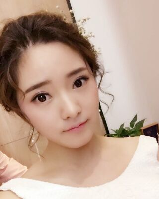 全切微創(chuàng)雙眼皮恢復(fù)圖，長沙希美蔣松林手術(shù)案例