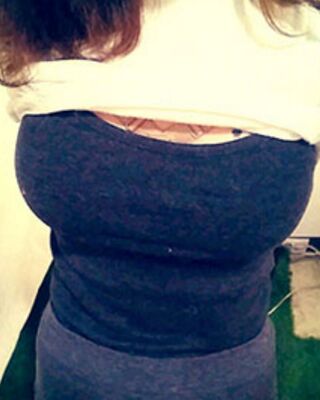 長沙希美假體隆胸前后對比果圖，A到C的變化