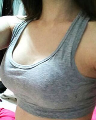 長沙希美假體隆胸前后對比果圖，A到C的變化