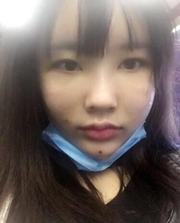 武漢美亞金國華醫(yī)生幫我做的自體脂肪全臉填充果恢復案例