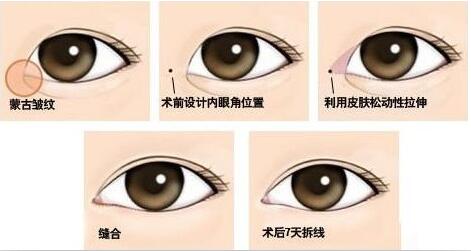 開(kāi)內(nèi)眼角原理圖，開(kāi)眼角大約多少錢(qián)
