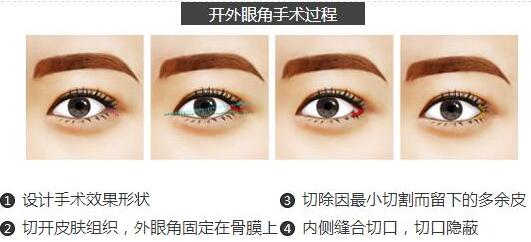 開(kāi)外眼角原理圖，開(kāi)眼角多少錢(qián)