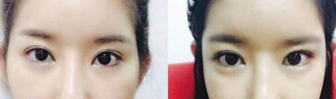開(kāi)外眼角前后對(duì)比圖，開(kāi)眼角價(jià)格