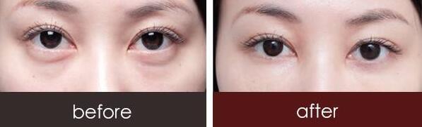 超聲波去眼袋前后對比圖，超聲波去眼袋多少錢？