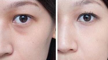 超聲波去眼袋前后對比圖，超聲波去眼袋多少錢？
