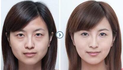 超聲波去眼袋前后對比圖，超聲波去眼袋多少錢？