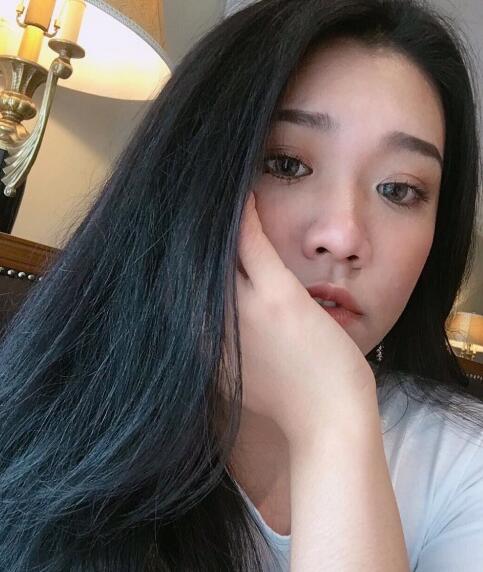 玻尿酸去法令紋前后對比圖分享