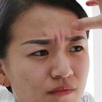 注射瘦臉去抬頭紋眉間紋恢復(fù)過程圖，真實(shí)案例分享