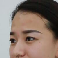 注射瘦臉去抬頭紋眉間紋恢復(fù)過程圖，真實(shí)案例分享