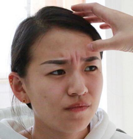 注射瘦臉去抬頭紋眉間紋恢復(fù)過(guò)程圖，真實(shí)案例分享