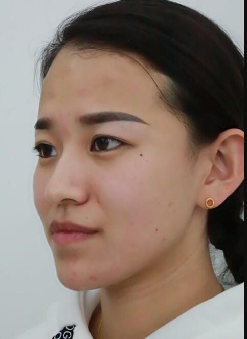 注射瘦臉去抬頭紋眉間紋恢復(fù)過(guò)程圖，真實(shí)案例分享