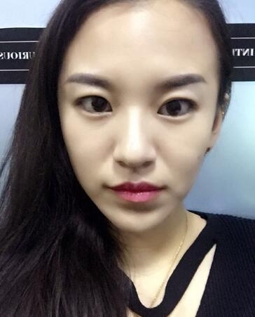 注射瘦臉去抬頭紋眉間紋恢復(fù)過(guò)程圖，真實(shí)案例分享