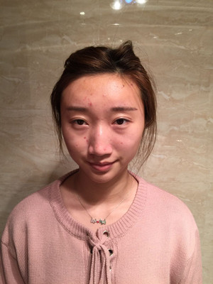 濰坊華美童艷梅醫(yī)生做的面部脂肪填充，大家來看看果怎么樣