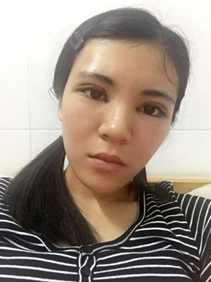 青?？等A馬晶醫(yī)生切開(kāi)雙眼皮真實(shí)案例分享