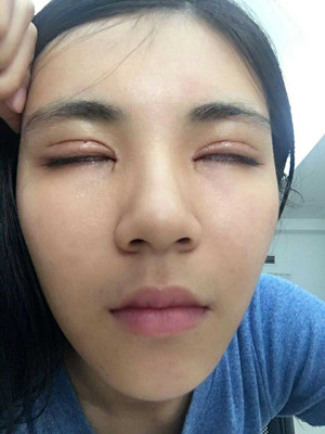 青?？等A馬晶醫(yī)生切開(kāi)雙眼皮真實(shí)案例分享